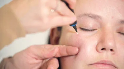 Aftercare Advice Following Milia Removal in Portsmouth