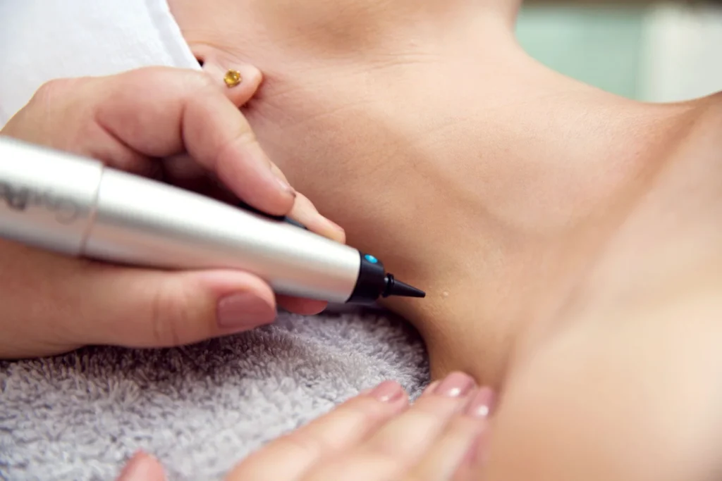 CryoPen Portsmouth precisely treating Molluscum Contagiosum lesions, showing safe and effective removal for faster healing by Cryosonic Portsmouth